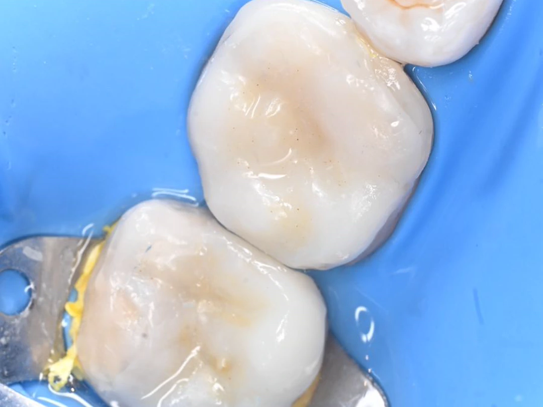 Las mismas dos muelas ya reconstruidas, con la anatomía de masticación devuelta