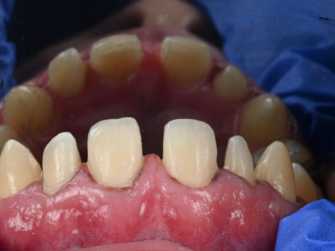 Dientes anteriores con los bordes desgastados y acortados, antes del tratamiento
