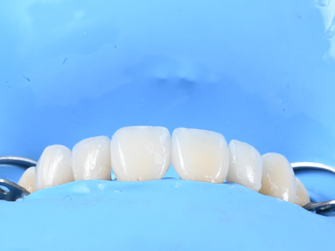 Los mismos dientes ya reconstruidos, bajo aislamiento absoluto con dique de goma